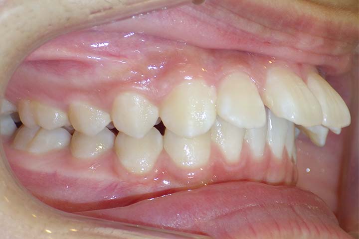 大人の歯並び治療症例