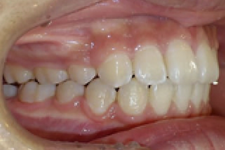 大人の歯並び治療症例