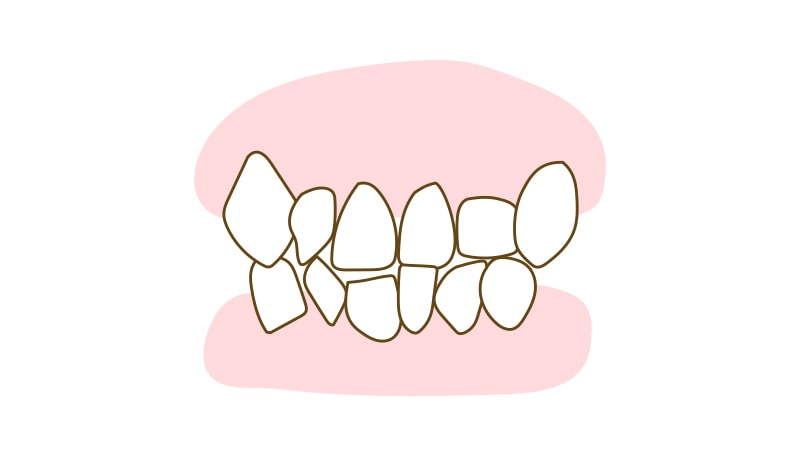 乱杭歯（凸凹）(叢生)